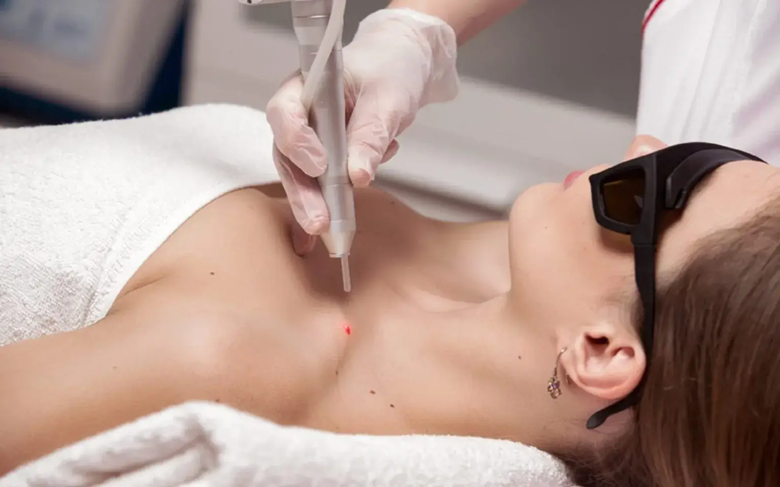 Лазерное удаление попиллом в Минске