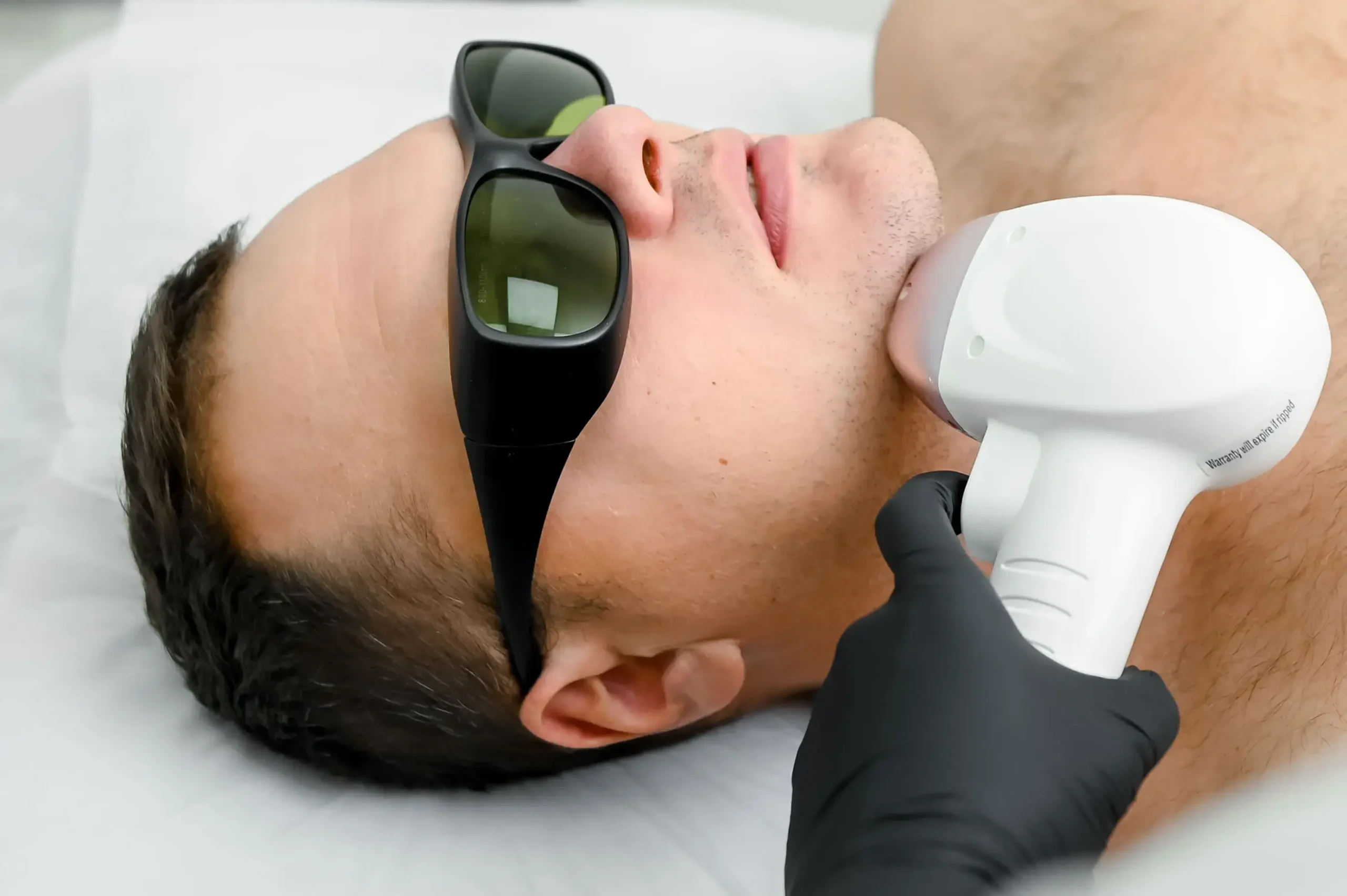 Пример лазерного удаления волос на лице у мужчин в косметологическом центре