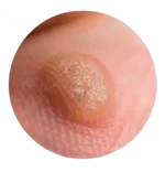 Бородавки - пример на теле и удаление