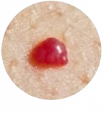 Гемангиомы на теле человека