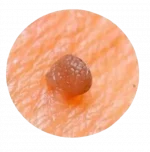 Паппиломы на теле человека