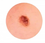 Родинки - так выглядят на теле